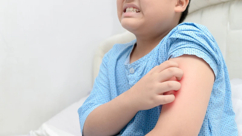 Nổi mề đay kiêng gì? Những điều cần tránh để kiểm soát bệnh hiệu quả.2