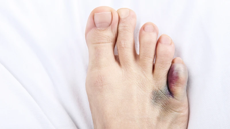 Khu vực quanh khớp bị trật thường sưng to, có thể kèm theo vết bầm do tụ máu dưới da