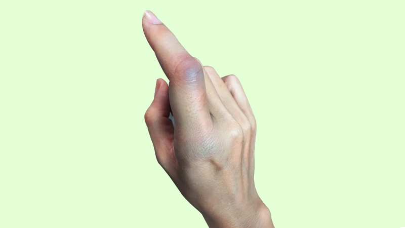 Khớp ngón tay nhanh chóng bị sưng nề do phản ứng viêm và tụ dịch quanh khớp