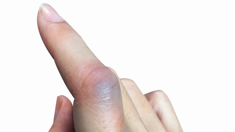 Ngay sau chấn thương, khu vực khớp ngón tay sẽ sưng lên nhanh chóng do phản ứng viêm và tụ máu dưới da