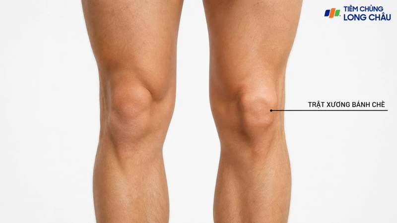 Trật xương bánh chè xảy ra khi bánh chè lệch khỏi rãnh lồi cầu đùi