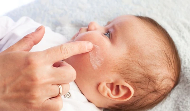Trẻ bị chàm sữa có tự hết không? Hướng dẫn chăm sóc trẻ bị chàm sữa đúng cách 3