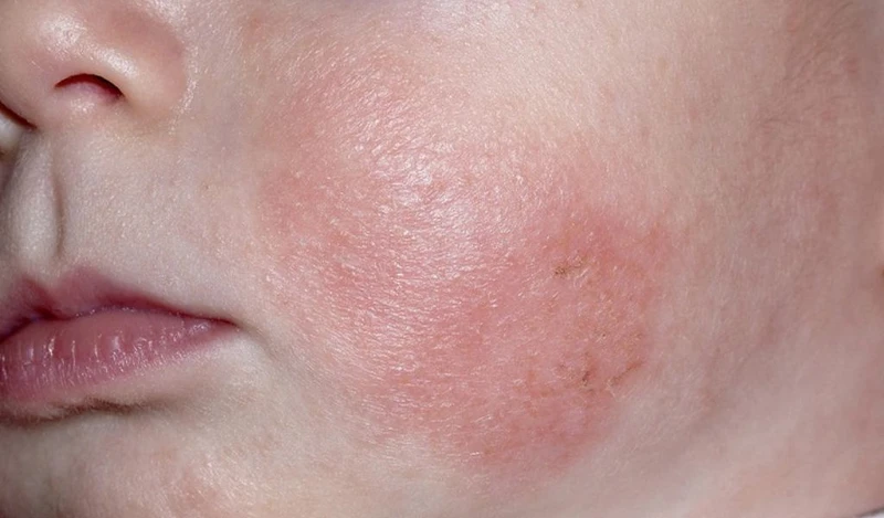 Trẻ bị chàm sữa có tự hết không? Hướng dẫn chăm sóc trẻ bị chàm sữa đúng cách 4
