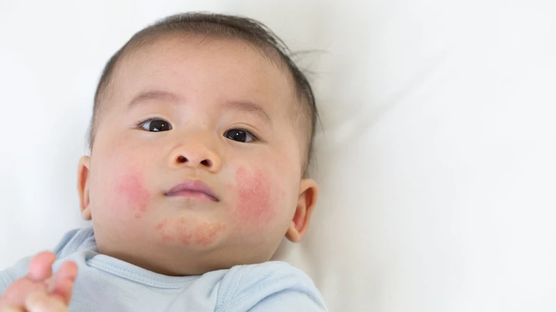 Thời tiết thay đổi đột ngột có thể kích thích da nhạy cảm phản ứng mạnh hơn