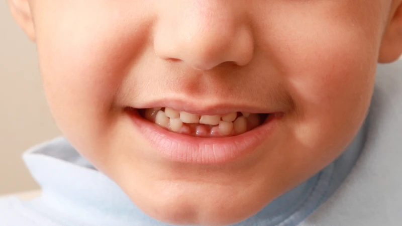 Răng sữa gãy không mọc lại, cần xử lý sớm để bảo vệ răng vĩnh viễn
