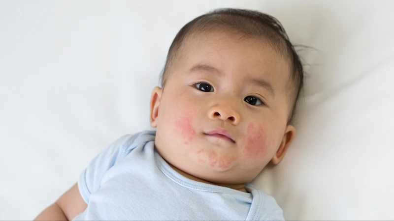 Viêm da tiếp xúc là nguyên nhân gây trẻ bị phát ban nhưng không sốt