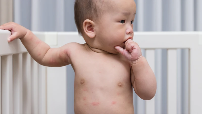 Hầu hết trường hợp trẻ bị phát ban nhưng không sốt thường không gây nguy hiểm