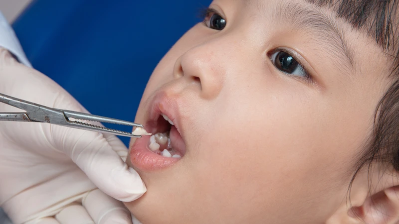 Nếu răng sữa sắp đến giai đoạn thay, bác sĩ sẽ chỉ định nhổ răng