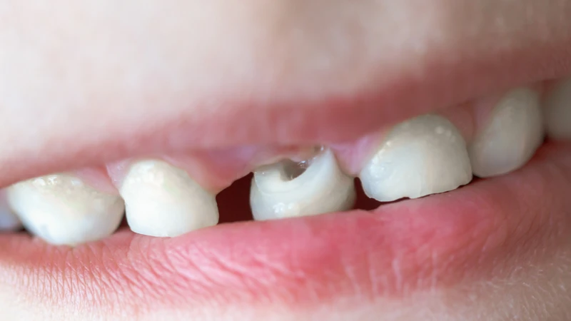Nhiều nguyên nhân có thể dẫn đến tình trạng răng sữa của trẻ rụng muộn hơn bình thường