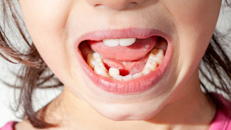 Răng mọc lệch lạc có thể ảnh hưởng đến thẩm mỹ và chức năng ăn nhai của trẻ