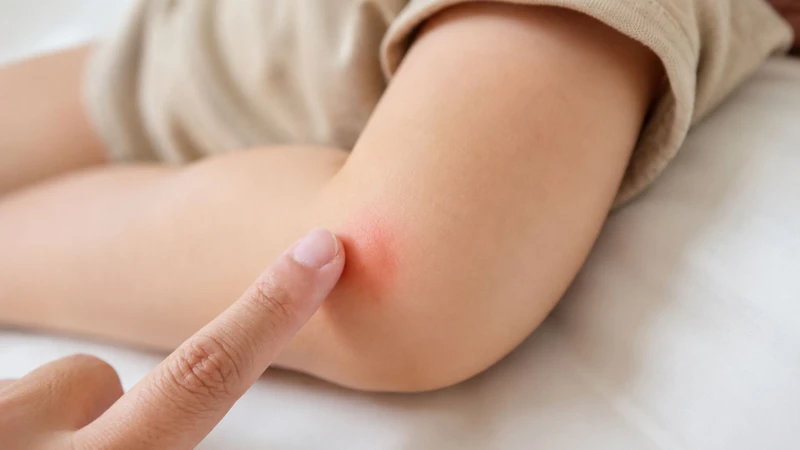 Xác định trẻ em bị muỗi đốt bôi gì cho nhanh khỏi giúp làn da nhạy cảm của bé được bảo vệ tối đa