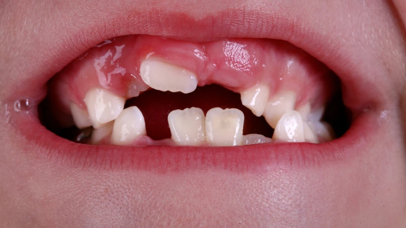 Di truyền và không gian trong cung hàm có thể ảnh hưởng đến trình tự mọc răng