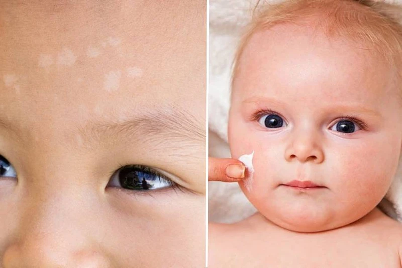 Trẻ sơ sinh bị lang trắng ở mặt do nguyên nhân gì? Cách chữa lang trắng hiệu quả 3