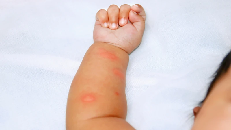 Cha mẹ có thể chườm mát để hỗ trợ giảm cảm giác ngứa và sưng tại vết đốt