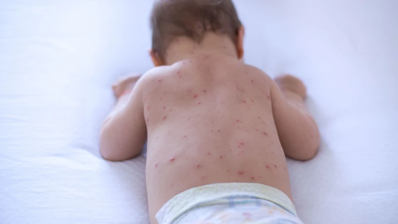 Thủy đậu ở trẻ sơ sinh là bệnh truyền nhiễm do virus Varicella-Zoster (VZV) gây ra