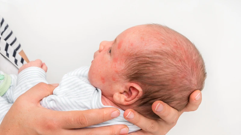 Trẻ sơ sinh nổi mẩn đỏ: Nguyên nhân và cách xử lý 1