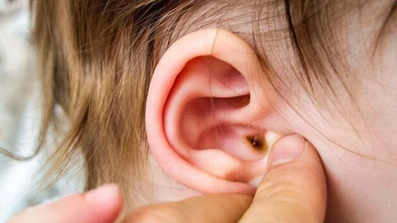 Trẻ sốt mãi không khỏi, hãy nghĩ đến viêm tai giữa kèm đau tai, chảy mủ