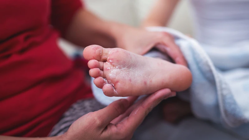 Triệu chứng tay chân miệng ở trẻ và cách phòng bệnh hiệu quả 3