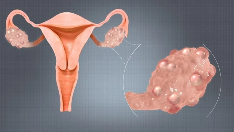 Kích thước nang trội là chỉ số quan trọng, giúp xác định nang trưởng thành và dự đoán thời điểm rụng trứng