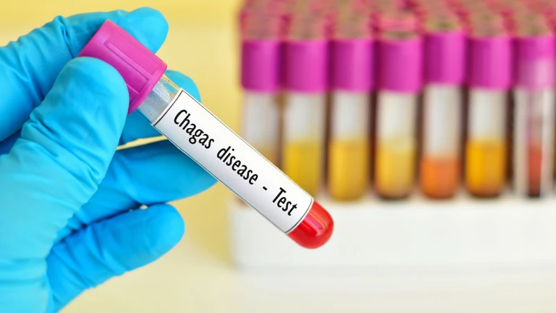 Chẩn đoán bệnh Chagas mạn tính có thể sử dụng xét nghiệm huyết thanh