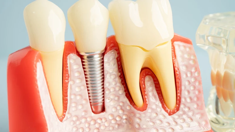 Tuổi thọ răng lấy tuỷ là bao lâu?