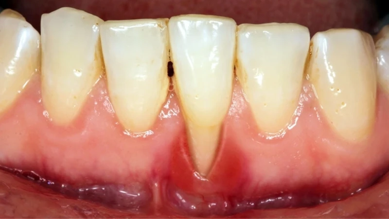 Tụt lợi có tự khỏi không? Tụt lợi không thể tự khỏi hoàn toàn