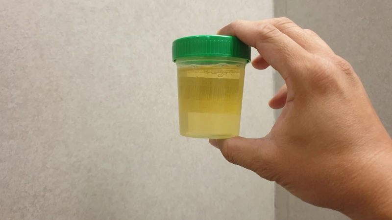Xét nghiệm tỷ lệ albumin creatinine thường sử dụng mẫu nước tiểu đầu tiên vào buổi sáng