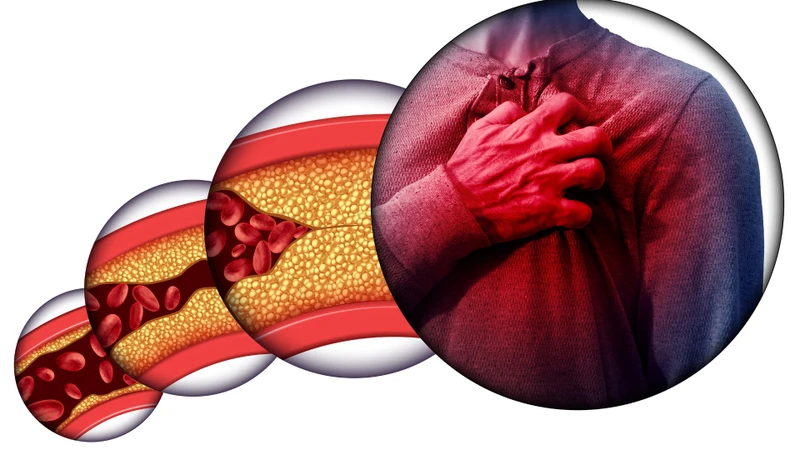 Tỷ lệ cholesterol cao có thể liên quan đến nguy cơ xơ vữa động mạch