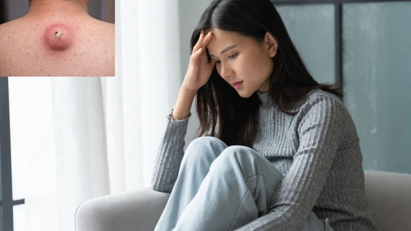 U bã đậu có nguy hiểm không là nỗi băn khoăn của nhiều độc giả