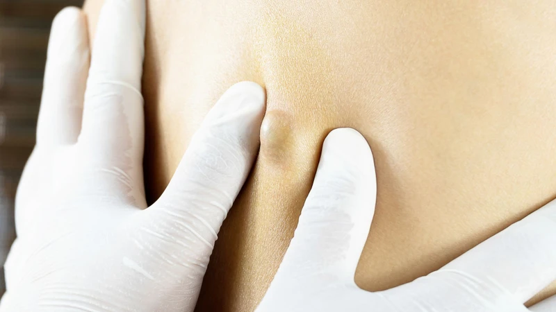 Tự ý nặn và chích u bã đậu là nguyên nhân khiến u bã đậu tiến triển gây biến chứng