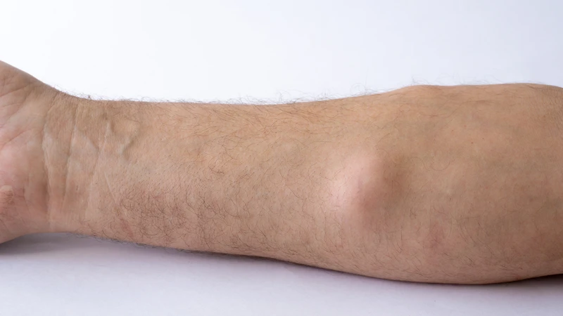 Việc hiểu đúng về u lành tính chính là chìa khóa giúp bạn bảo vệ sức khỏe lâu dài