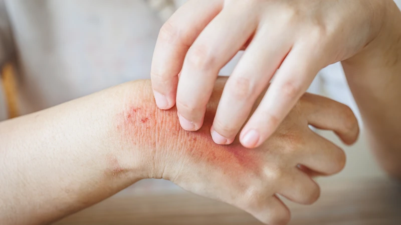 Các biểu hiện trên da như phát ban, ngứa có thể là dấu hiệu của bệnh
