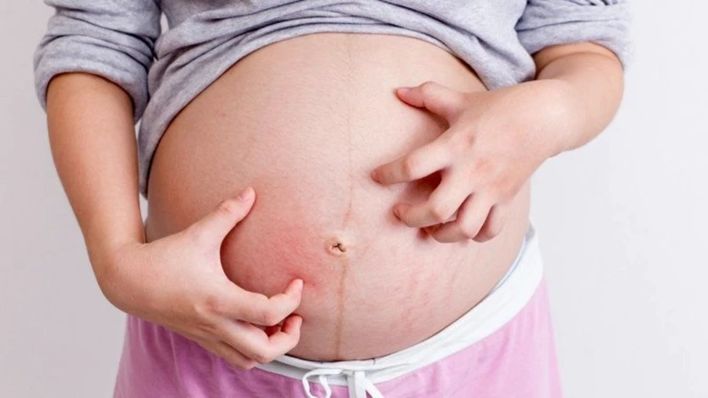Ứ mật thai kỳ là tình trạng gan của mẹ bầu không bài tiết mật đúng cách, khiến muối mật tích tụ trong máu và gây ngứa dữ dội