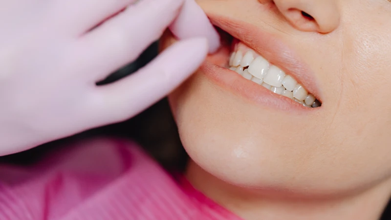 Các dấu hiệu của u máu trong miệng có thể dễ dàng quan sát