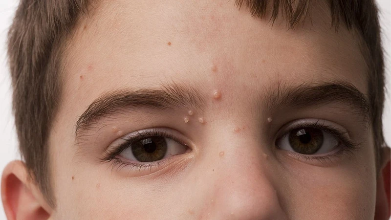 U mềm lây không tái phát từ nốt cũ, nhưng vẫn có thể nhiễm lại nếu tiếp xúc virus