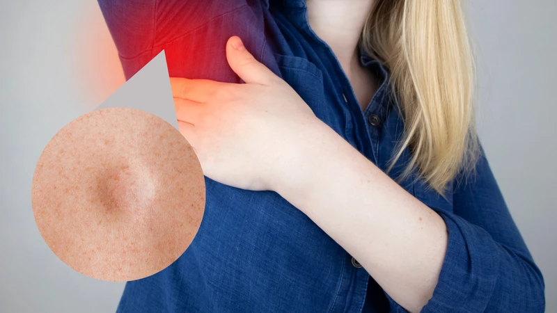 U mỡ ở nách thường mềm và không gây đau khi sờ nắn