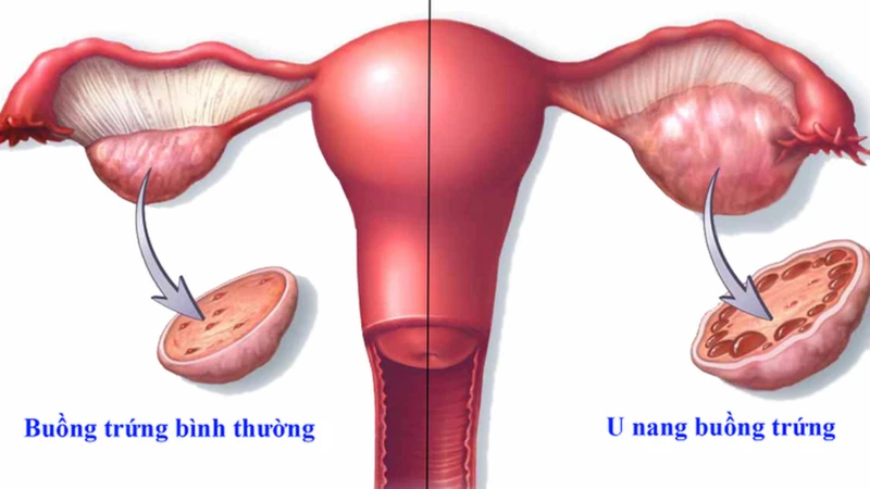 U nang buồng trứng phải là gì? Có cần phẫu thuật không? 1