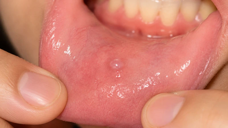 U nang thường có dạng tròn hoặc hình vòm, nổi lên ở mặt trong môi và thường gặp ở môi dưới