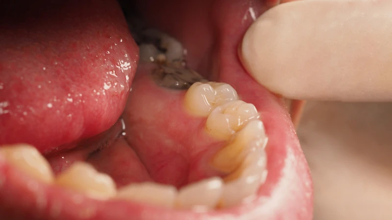 U nang răng là gì? Những thông tin quan trọng cần biết 1