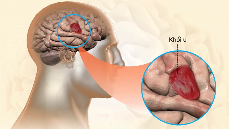 U nguyên bào thần kinh là một loại ung thư phát triển từ các tế bào thần kinh non, thường gặp ở trẻ nhỏ