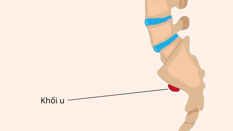 U nguyên sống thường xuất hiện ở khu vực nền sọ và xương cùng cột sống
