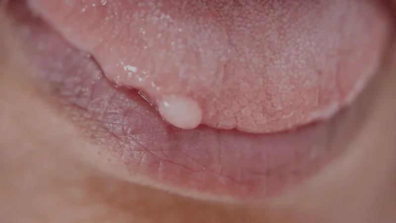 U nhú lưỡi là gì? Nguyên nhân, triệu chứng và cách điều trị 3