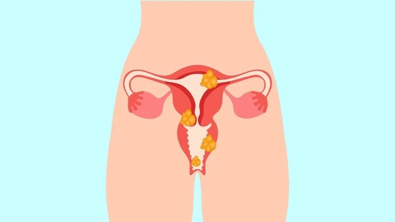 U xơ tử cung lành tính là bệnh lý phổ biến và thường tiến triển chậm