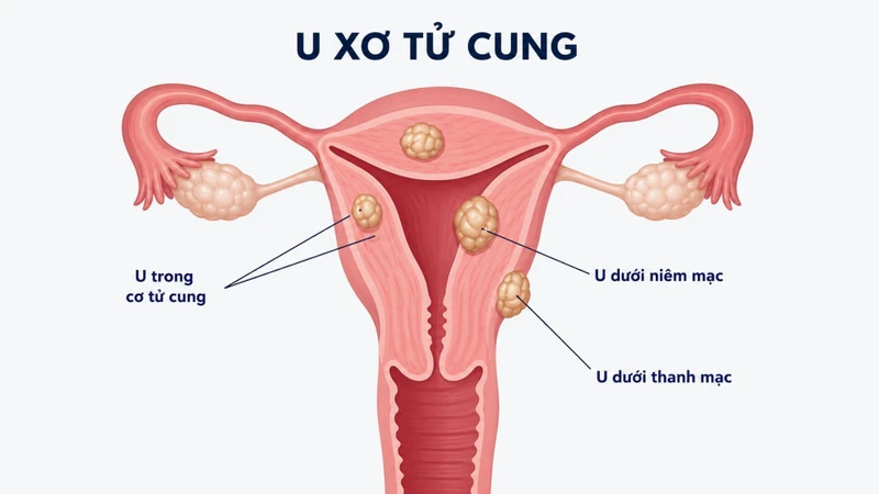 Hiểu rõ cấu trúc và các vấn đề liên quan đến tử cung giúp bảo vệ sức khỏe sinh sản