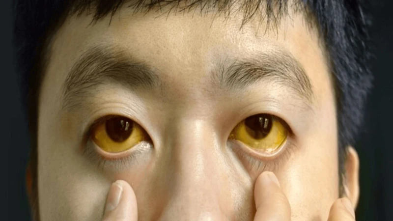 Ung thư gan giai đoạn 2: Triệu chứng, điều trị và cách phòng ngừa hiệu quả 2
