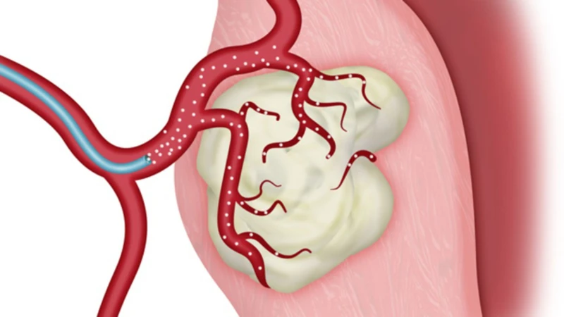 Ung thư gan giai đoạn 3: Mức độ nguy hiểm, phương pháp điều trị và phòng bệnh 4