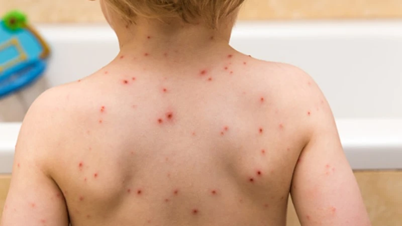 Vắc xin Barycela giúp phòng ngừa thủy đậu, một bệnh truyền nhiễm do virus varicella-zoster gây nên