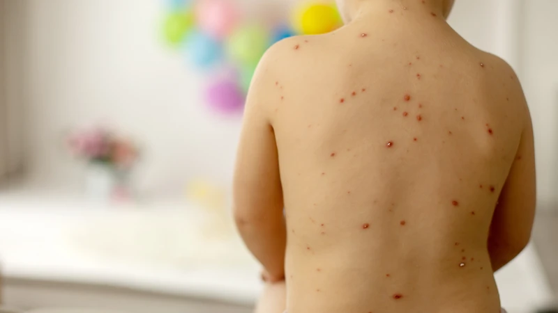 Khi mắc bệnh thủy đậu trẻ có nguy cơ gặp phải các biến chứng nghiêm trọng