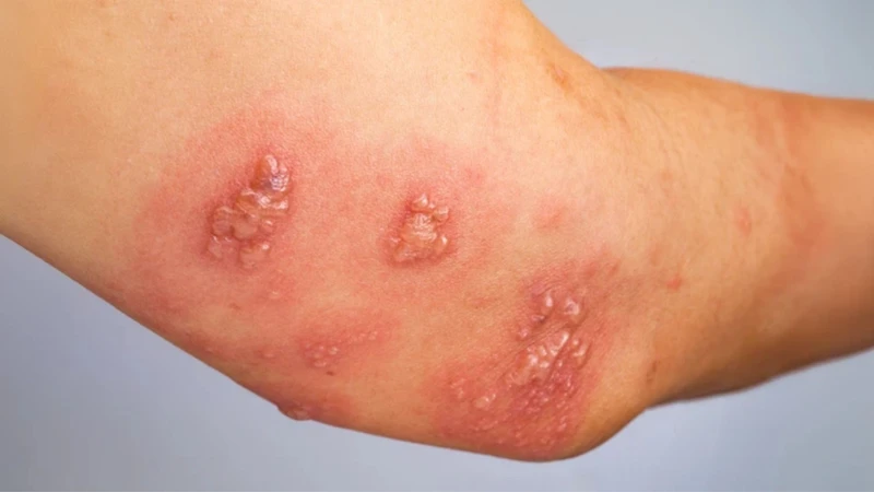 Herpes simplex thường được kiểm soát bằng thuốc kháng virus
