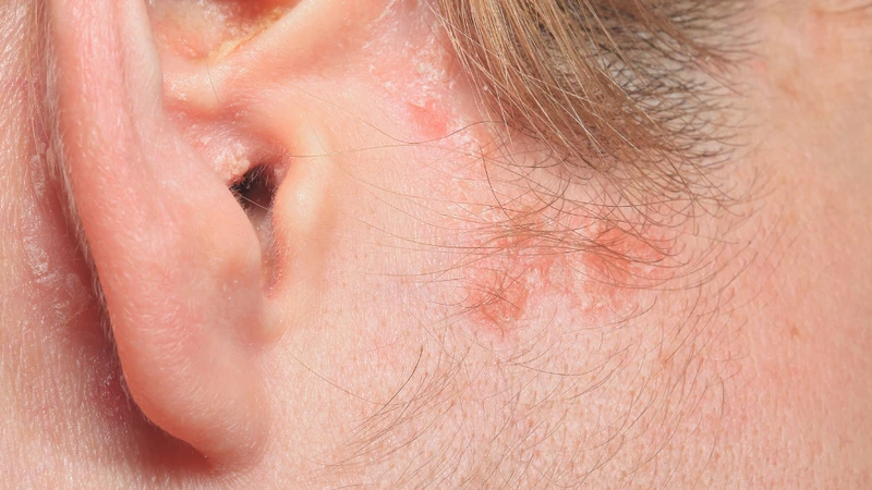 Vành tai bị đóng vảy ở người lớn là tình trạng da liễu thường gặp